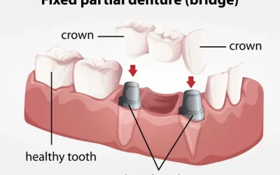 Dental Implant Longevity: What Kennewick, WA Patients Should Know About How Long Implants Last