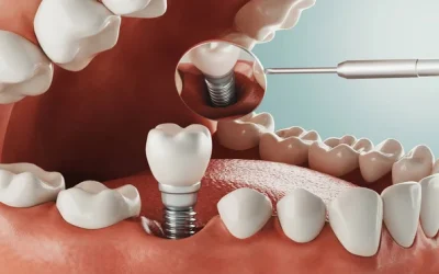 Dental Implant Procedure in Kennewick, WA: A Step-by-Step Guide From Consultation to Final Crown